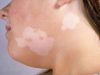 FAQ’s n Vitiligo and how to treat it