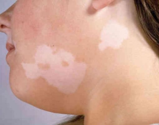 FAQ’s n Vitiligo and how to treat it
