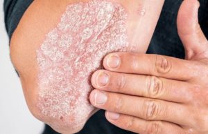 Can psoriasis be treated through homeopathy?