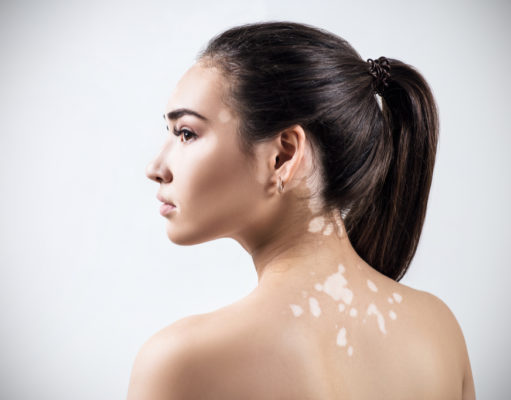 Vitiligo: Things you need to know