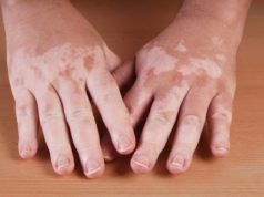 Homeopathic Treatment for Vitiligo