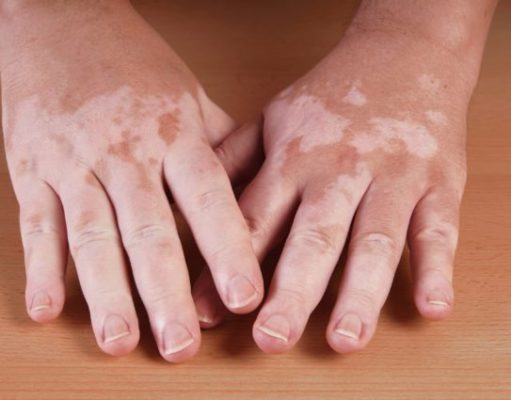 Homeopathic Treatment for Vitiligo