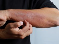 Things you should know about Eczema
