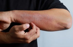 Things you should know about Eczema