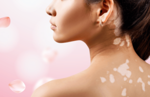 Skin grafting for Vitiligo – Does if offer permanent cure?