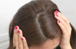 Make your hair dandruff free