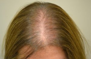 Psychological impact of hair loss in women