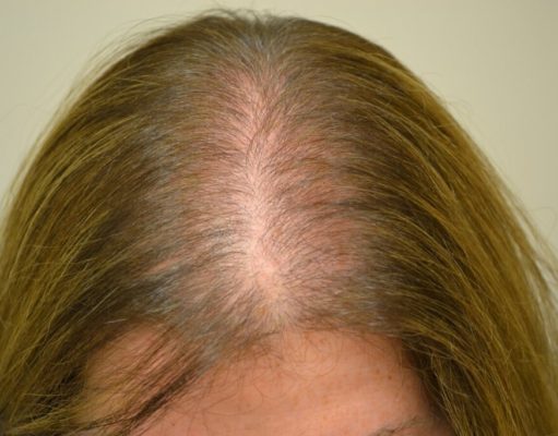 Psychological impact of hair loss in women