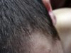 Scalp Psoriasis: Cure it the natural way