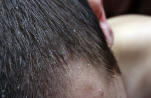 Scalp Psoriasis: Cure it the natural way