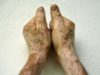 Treatment Options for Vitiligo