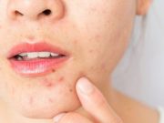 What are the main causes of Acne?