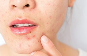 What are the main causes of Acne?