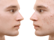 How to tackle the emotional aspects related to acne