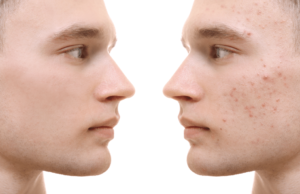 How to tackle the emotional aspects related to acne