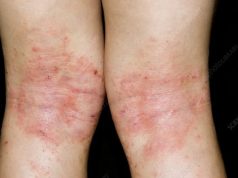 Types of Eczema explained