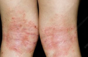 Types of Eczema explained